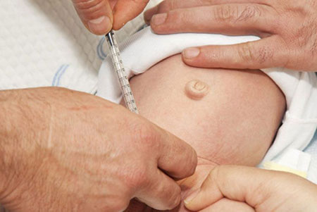 caring infant circumcision 23 1 - روش های مراقبت بعد از ختنه نوزاد