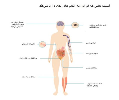 آیا بیماری ام اس کشنده است؟ آسیب ms - آیا بیماری ام اس کشنده است؟