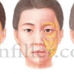 تزریق ژل زیر چشم تزریق ژل زیر چشم