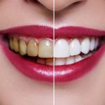 انتخاب بهترین متخصص زیبایی دندان برای درمان کامپوزیت