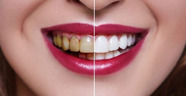 image 5a0326a61eace867d7fbd423c75a70e826f62e3c 600x312 - انتخاب بهترین متخصص زیبایی دندان برای درمان کامپوزیت