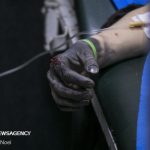 سوختگی دست و صورت یک کودک ۱۴ ساله در پی انفجار نارنجک