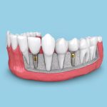 ایمپلنت ایرانی خوبه ؟ ( + مزایا و معایب ) ایمپلنت ایرانی خوبه ؟ ( + مزایا و معایب )