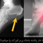 آیا خار پاشنه باعث ورم قوزک پا میشود؟ آیا خار پاشنه باعث ورم قوزک پا میشود؟