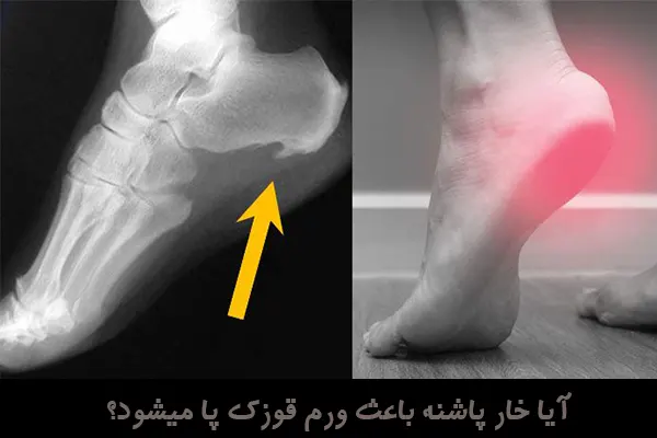 آیا خار پاشنه باعث ورم قوزک پا میشود؟ آیا خار پاشنه باعث ورم قوزک پا میشود؟
