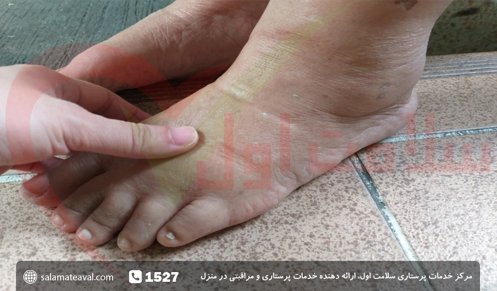 ورم پای سالمندان