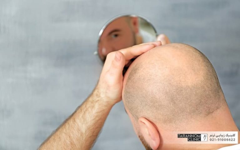 بهترین روش کاشت مو برای سال ۱۴۰۴ چیست؟ بهترین روش کاشت مو برای سال ۱۴۰۴ چیست؟