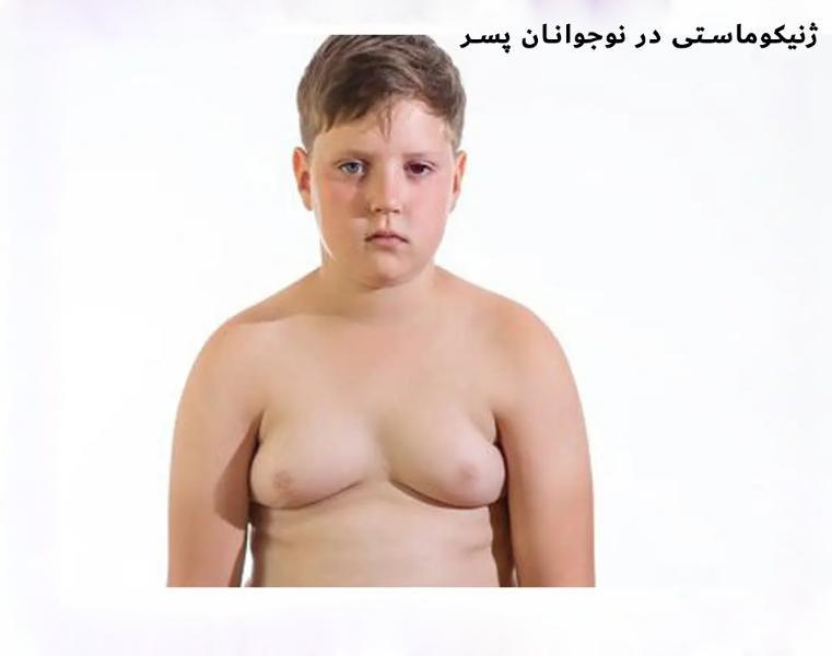 چرا سینههای پسرم بزرگ شده چرا سینههای پسرم بزرگ شده