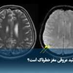 ویدیو/ چرا آمیلوئید عروقی مغز خطرناک است؟